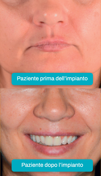 Prima/dopo impianto dentale